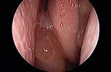 Images of Medication For Nasal Polyps