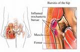 Hip Muscle Strengthening Exercises Bursitis Photos