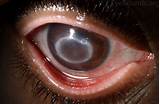 Parasite In Eye Treatment Photos