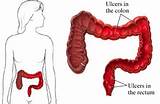 Images of Ulcerative Colitis Joint Pain Treatment