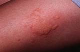 Hives Doctor Treatment Images