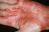 Pictures of Hand Psoriasis Treatment