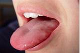 Photos of Allergic Reaction Swollen Tongue Treatment