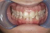 Tooth Abrasion Treatment Cost Images