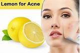 Lemon Home Remedies For Acne Photos