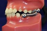 Photos of Orthodontic Flossers For Braces