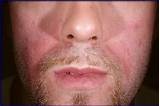 Images of Seborrheic Dermatitis Beard Treatment