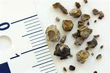 Images of Kidney Stone Doctor