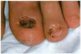 Psoriatic Nail Dystrophy Home Remedies