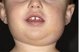 Photos of What Is The Treatment For Mumps Disease