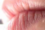 Images of Lip Cracks Home Remedies
