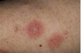 Eczema On Back Treatment Images