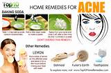 Acne Help Home Remedies Pictures