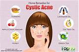 Photos of Home Remedies Cystic Acne