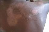 Eczema Treatment African American Skin Images