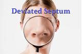 Deviated Septum And Polyps Surgery Recovery