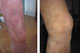 Photos of New Atopic Dermatitis Treatments