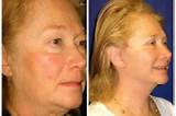 Images of Post Facelift Care
