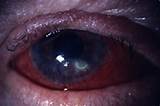 Photos of Corneal Ulcer Treatment Medications