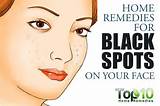 Photos of Black Spot On Face Removal Home Remedy