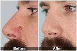 Laser Treatment For Moles On Face Side Effects Images