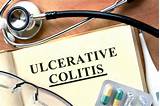 Feces Treatment For Colitis Pictures