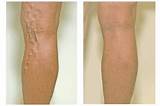 Images of Varicose Veins Laser Treatment Prices