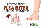 Human Flea Bites Home Remedies Photos