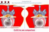 Laser Treatment For Bulging Disc Images