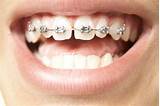 Where To Get Orthodontic Rubber Bands Photos
