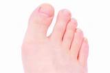 How Do Doctors Remove Bunions Pictures