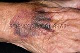 Bruised Hand Treatment Photos