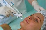 Images of Hair Removal Laser Side Effects Cancer