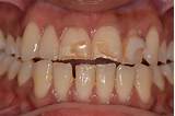 Porcelain Veneers Cost With Insurance Images