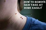 Inflamed Skin Tag Home Remedies Photos