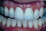 Images of Medication For Sensitive Teeth
