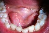 Pictures of Floor Of Mouth Cancer