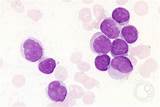Acute Myeloid Leukemia Life Expectancy Without Treatment Pictures