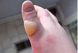 Photos of Medication For Blisters On Feet