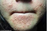 Pictures of Allergic Reaction Acne Treatment