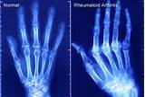 What Doctor To See For Arthritis In Hands Pictures