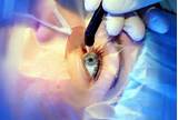 Refractive Lasik Surgery Pictures