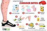 Home Remedies For Chigger Bites On Dogs Photos