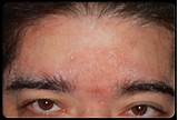 Eczema On Forehead Treatment Images