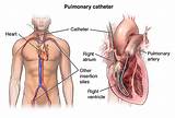 Heart Catheter Ablation Recovery