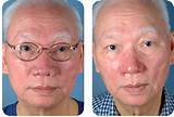 Laser Treatment For Moles On Face Side Effects Photos