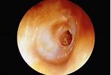 Images of Medication For Inner Ear Infection In Adults