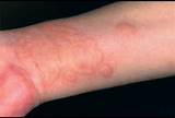 Images of Chronic Hives Medication