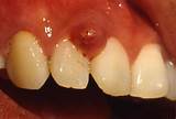 Pictures of Gum Inflammation Medication