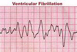 Images of Heart Arrhythmia Monitor
